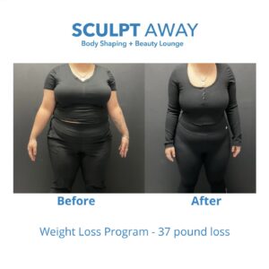 Before and after Tirzepatide weight loss results in San Antonio